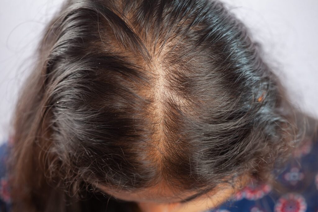 Voile et chute de cheveux : pourquoi le sommet est touché en premier ?